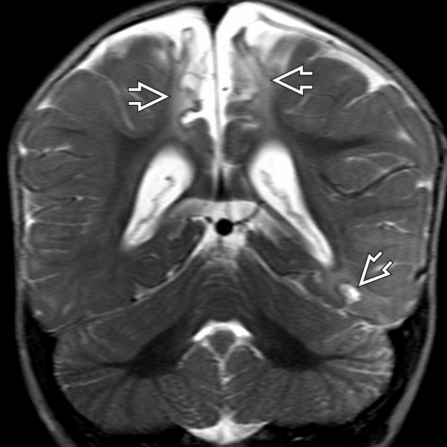 Coronal T2 MR in the same child 9 months later shows focal volume loss in both areas of injury , with associated enlargement of the ventricles & interhemispheric fissure.