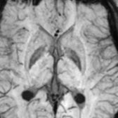 Axial SWI MR in the same patient shows bilateral mild increased GP iron deposition . Note the hyperintense medial medullary lamina  in between GP interna & externa (like in MPAN). Also notice the excessive iron deposition in the bilateral lateral ventricle trigone choroid plexus  in this WSS patient.