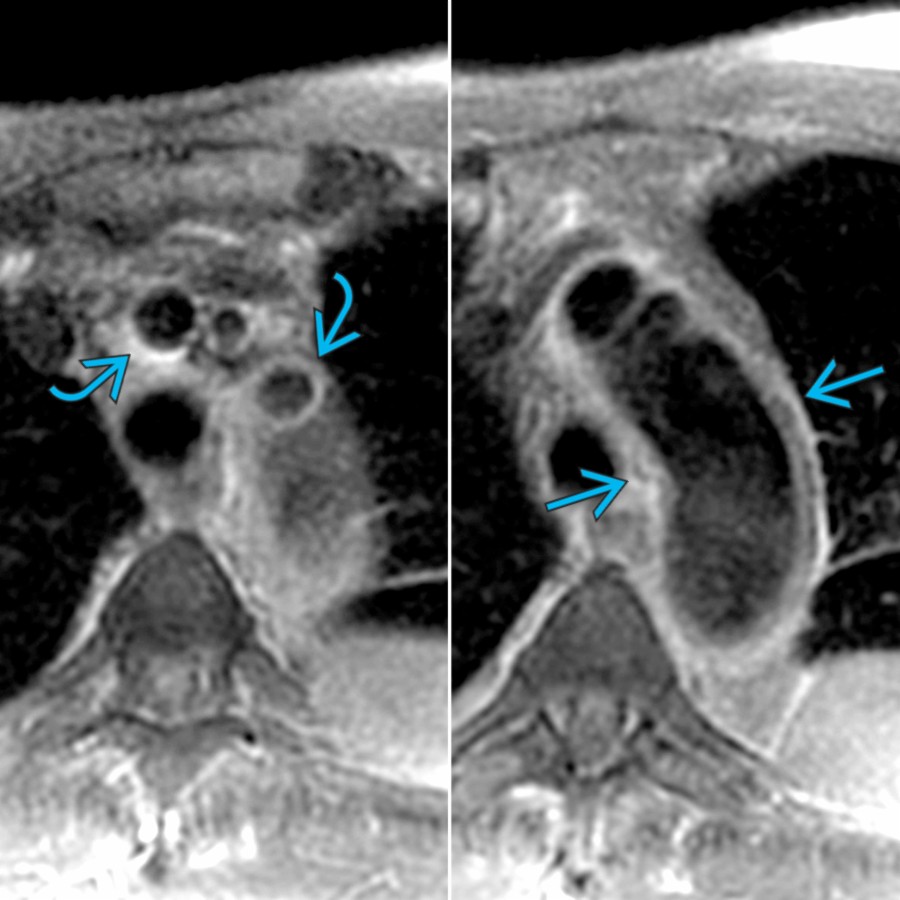 Axial double inversion recovery FS MR in the same patient at different levels shows diffuse high signal of the aortic wall  as well as head and neck vessels . MR is the preferred method to assess for active inflammation also seen in the form of vessel parietal enhancement after intravenous gadolinium.