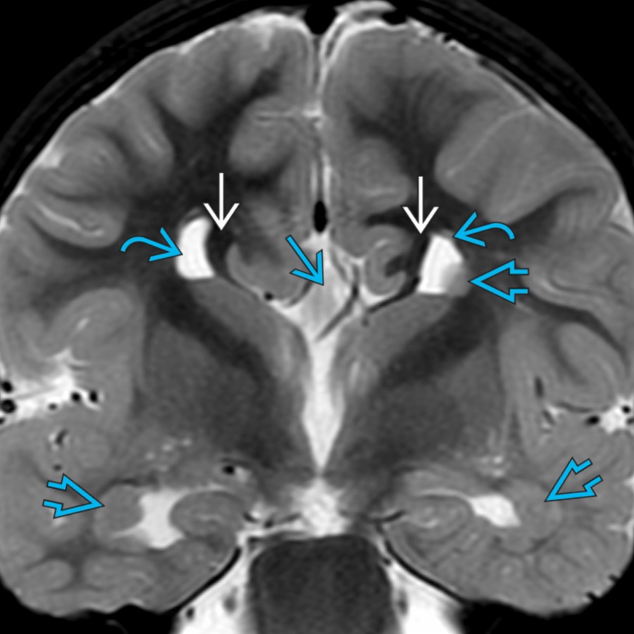 Coronal T2 MR in a 4 year old with callosal agenesis shows widely spaced upturned lateral ventricular frontal horns , a high-riding 3rd ventricle , & bilateral Probst bundles . Also note the extensive periventricular gray matter (GM) heterotopia .