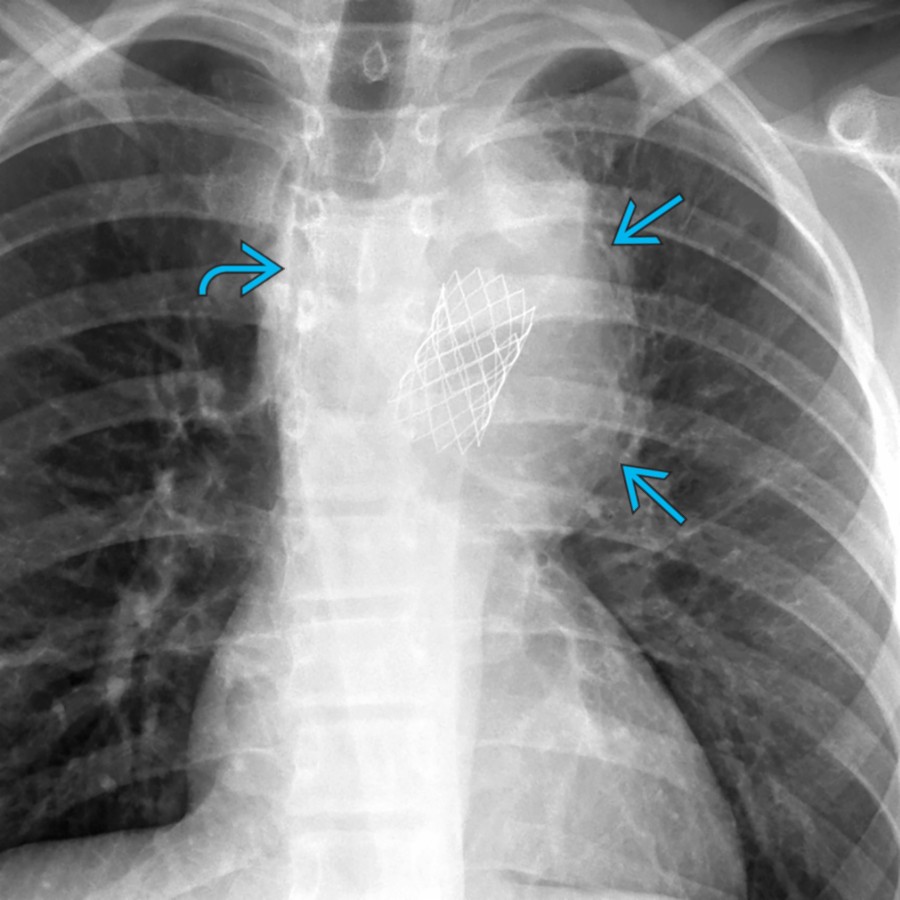 PA chest radiograph of a patient with a history of bicuspid aortic valve and coarctation status post stent placement in the proximal descending thoracic aorta shows new dilation of the aortic arch and descending aorta . The intrathoracic trachea is displaced to the right .