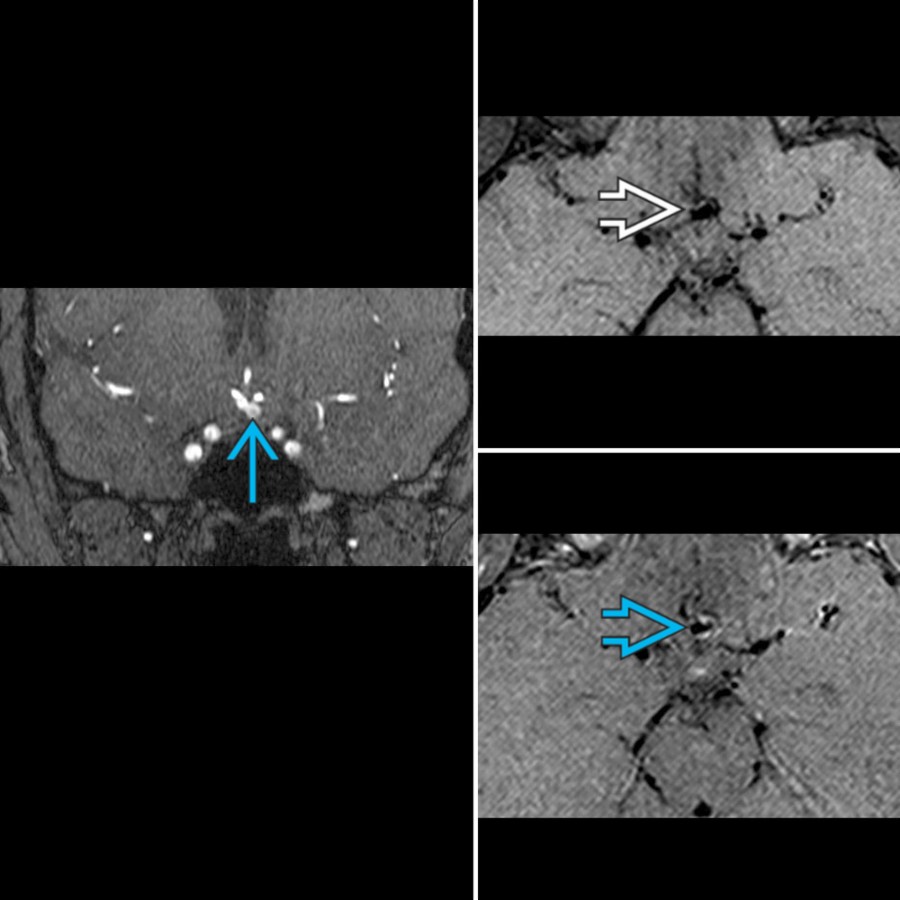 MRA 3D TOF source image shows an anterior communicating artery saccular aneurysm . Vessel wall MR (vwMR) images show areas of wall enhancement comparing pre-  and postcontrast  DANTE T1 SPACE, thought to be linked to growth and rupture risk.