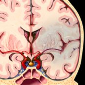 Coronal graphic illustrates left M1 occlusion. Proximal occlusion affects the entire middle cerebral artery (MCA) territory, including the basal ganglia (perfused by lenticulostriate arteries ). Acute ischemia is often identified by subtle loss of the gray matter-white matter interfaces with blurring of the basal ganglia and an insular ribbon sign on the initial CT.