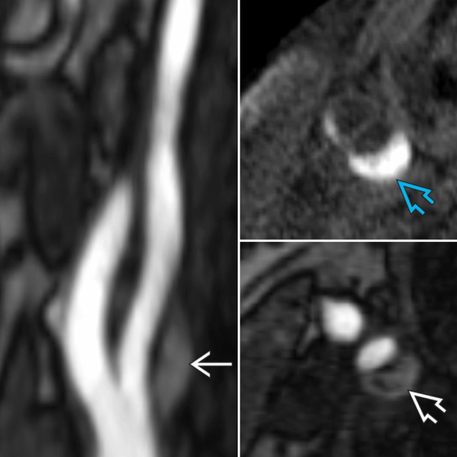 Intraplaque hemorrhage (IPH) can be detected on MRA. 3D TOF can detect IPH (sagittal  and axial ), but TOF and conventional T1 FS MR are less accurate than MPRAGE  when compared to histology.