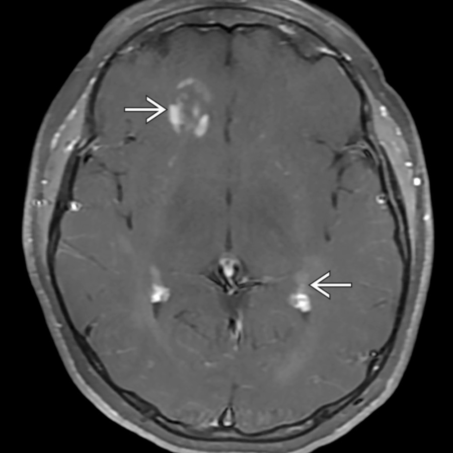 Axial T1 C+ FS MR in the same patient  reveals the characteristic heterogeneous enhancement pattern for a demyelinating process in these more recent lesions , meeting McDonald criteria for dissemination in space and time.