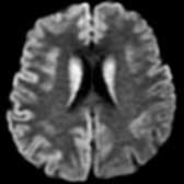 Axial DWI MR demonstrates bright signal of restricted diffusion in bodies of both caudate nuclei.
