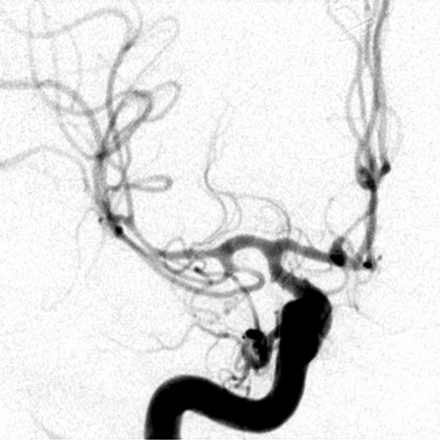 DSA after 25-mg verapamil infusion into right ICA shows increase in caliber of all vasospastic segments. The patient received additional IA verapamil in the following days. Recurrent vasospasm after chemical angioplasty is to be expected, but balloon angioplasty is more durable.