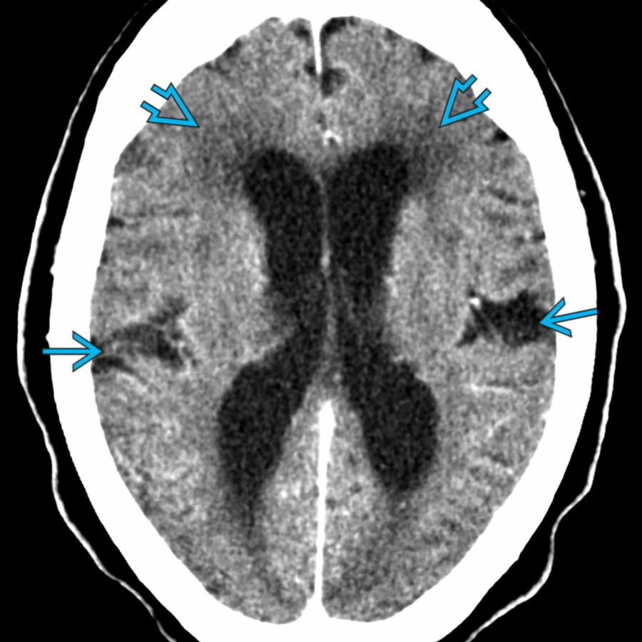 Axial CECT demonstrates typical findings suggestive of iNPH. There is enlargement of the lateral ventricles and sylvian fissures   out of proportion to the amount of general sulcal enlargement. The frontal horns show a characteristic rounded appearance. Periventricular hypodensities    could reflect interstitial migration of CSF.