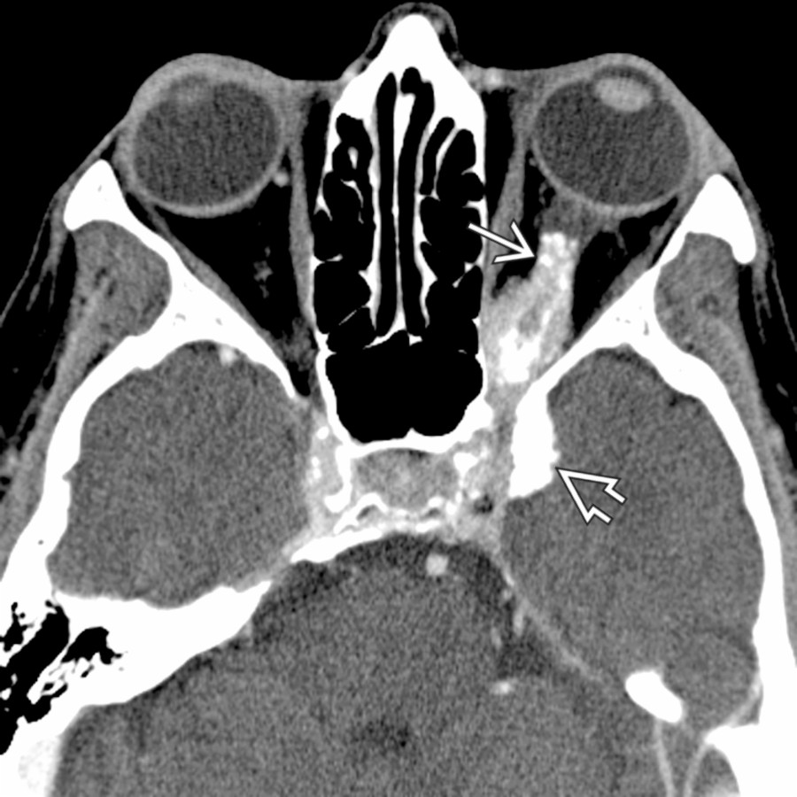 Axial CECT shows an extensive plaque-like calcification along the optic nerve sheath  and left anterolateral cavernous sinus  related to a meningioma. Strong, homogeneous enhancement is typical following contrast administration.