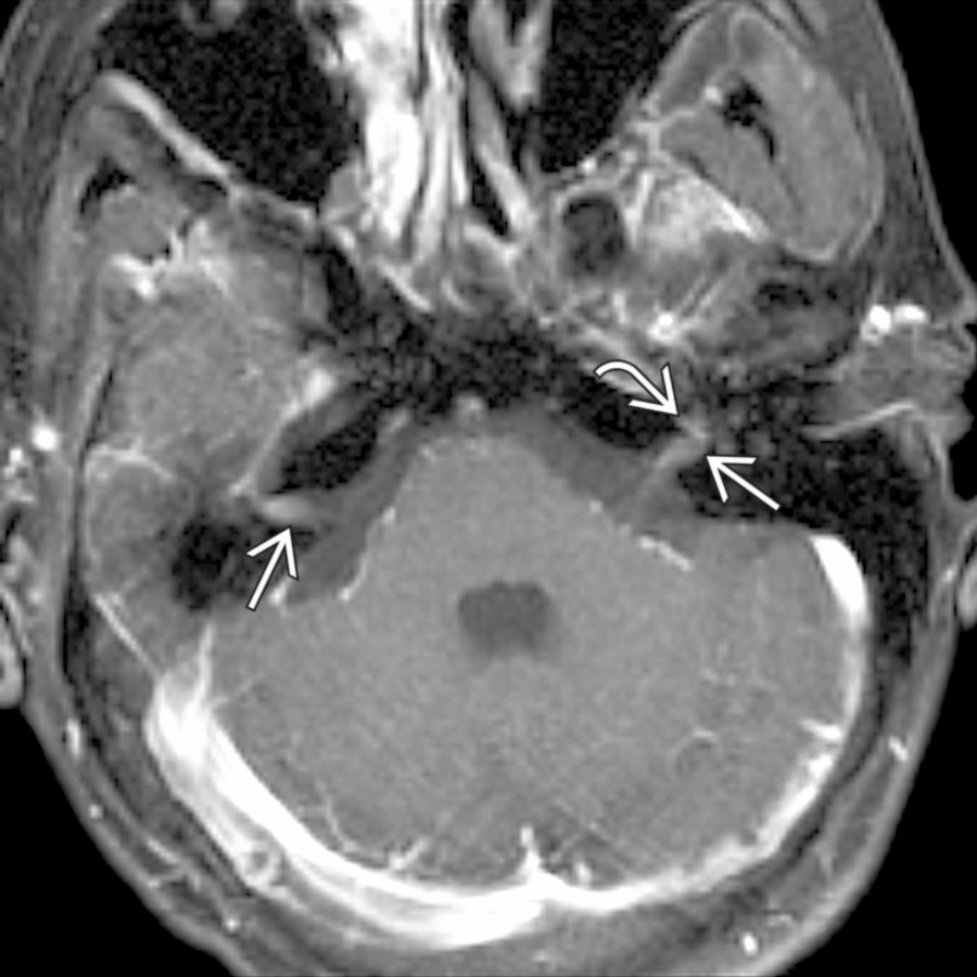 Axial T1 C+ MR in a patient with adenocarcinoma shows enhancing metastatic lesions in both IAC cisterns . Note the transmodiolar extension on left .
