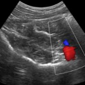 Distally, the fibers from the iliacus muscle converge and insert into the lateral side of the psoas muscle to form the iliopsoas muscle. Common iliac vessels can be seen medially.