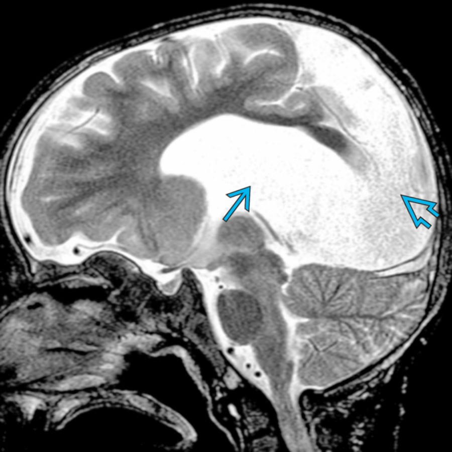 Midline sagittal T2 MR shows absence of the CC in a patient with alobar holoprosencephaly. There is continuity of frontal WM & GM across the midline with a large dorsal cyst  that communicates with a monoventricle . Note the lack of a vermian primary fissure due to associated rhombencephalosynapsis.