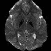 Axial zero B DWI MR accentuates the T2 hypointensity  of the iron deposition in this patient with PKAN. Note the classic eye of the tiger appearance. This sequence is often referred to as the "poor man's GRE" as it shows "blooming" of blood products and mineral deposition, similar to the T2* sequences.