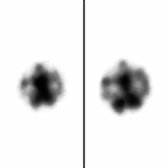 Axial 24-hour axial SPECT in the same patient demonstrates marked ventricle activity , confirming the presence of NPH.