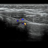 Also in the transverse plane, color Doppler is applied to show the right inferior epigastric artery and vein deep to the rectus abdominis muscle. These are important to identify in order to avoid when performing procedures and are landmarks that are used to determine hernia type when present.