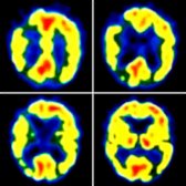 Axial FDG PET in a patient with multiinfarct dementia demonstrates multiple wedge-shaped areas of hypometabolism  due to chronic infarcts. (Courtesy A. Ali, MD.)