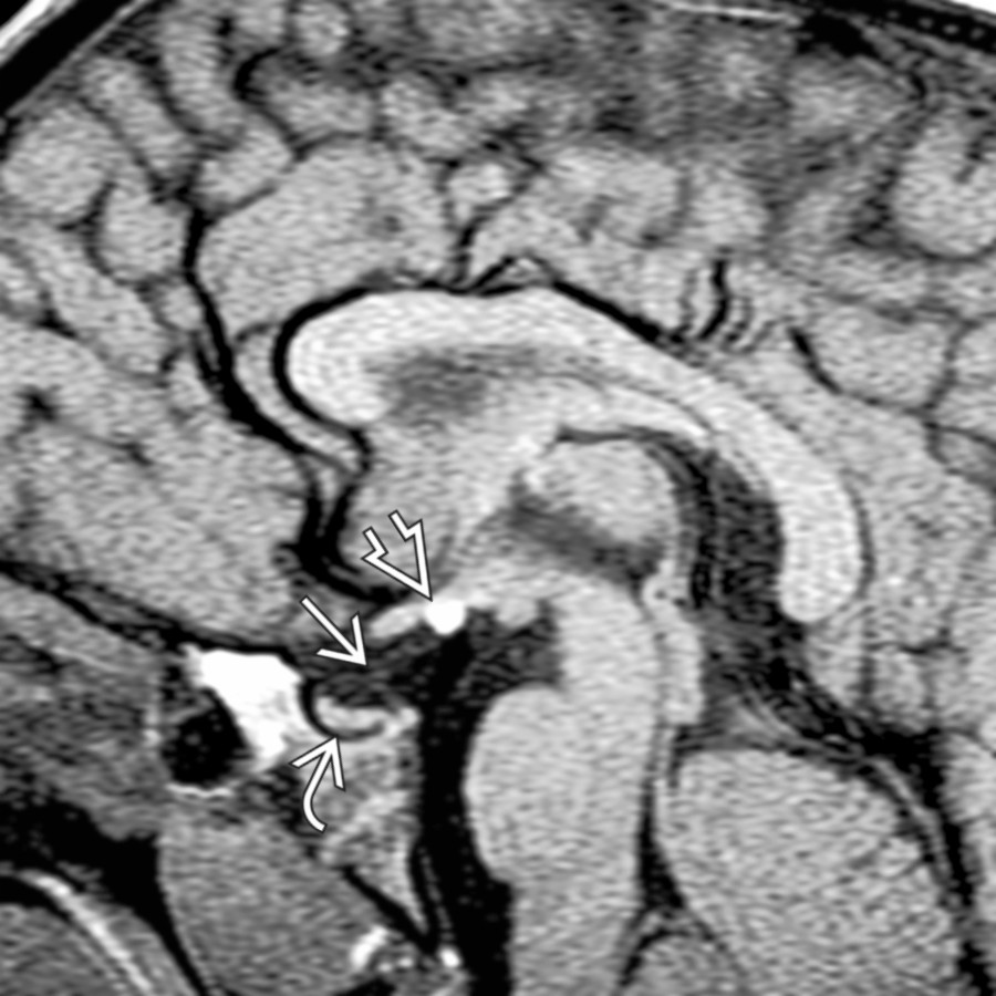 Sagittal T1 MR in a 2-year-old child with short stature and abnormally low bone age shows an absent infundibular stalk , ectopic posterior pituitary bright spot , and small pituitary gland .