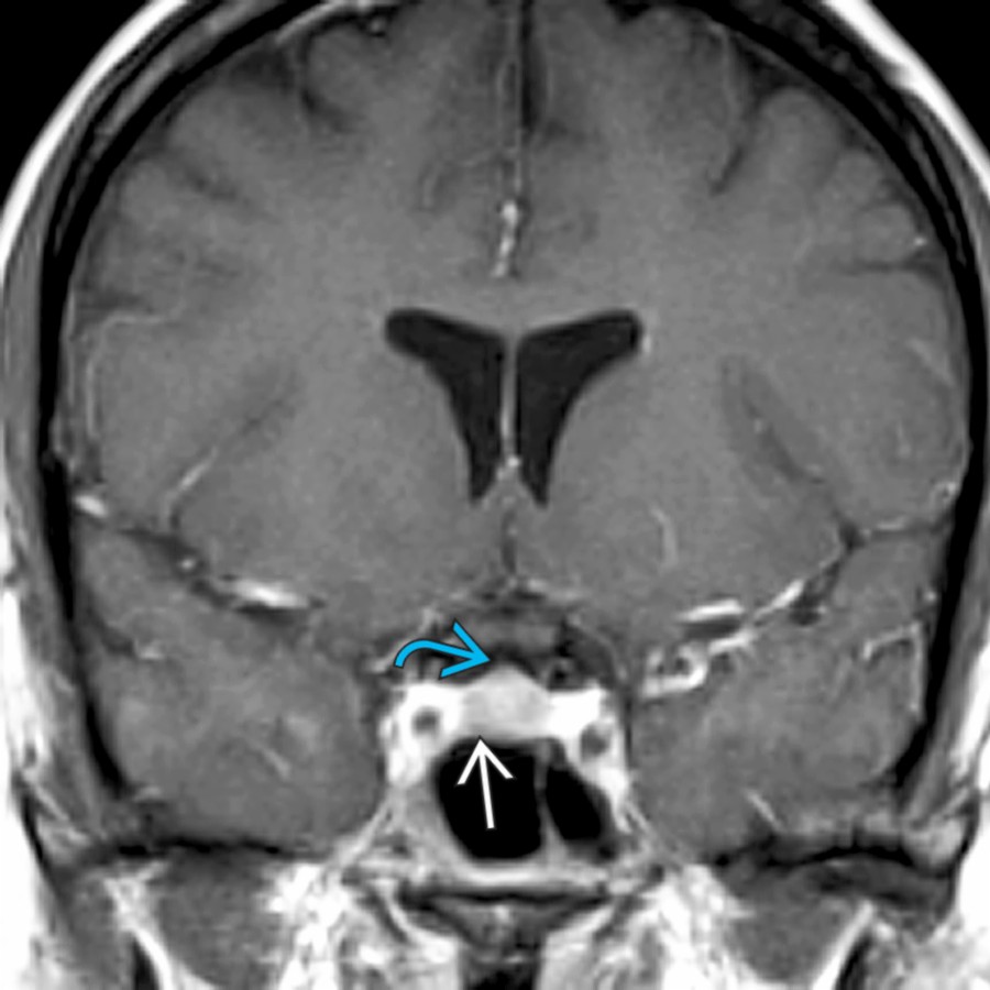 Coronal T1 C+ MR in a young, menstruating female shows slight, inhomogeneous enhancement  in this gland with mild upward bulging . No frank intrapituitary cysts are identified; the mild inhomogeneity in enhancement is normal.
