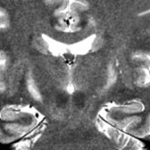 Coronal T2WI MR shows hyperintense CSTs  in a patient with ALS. (Courtesy O.Q. Castro, MD.)