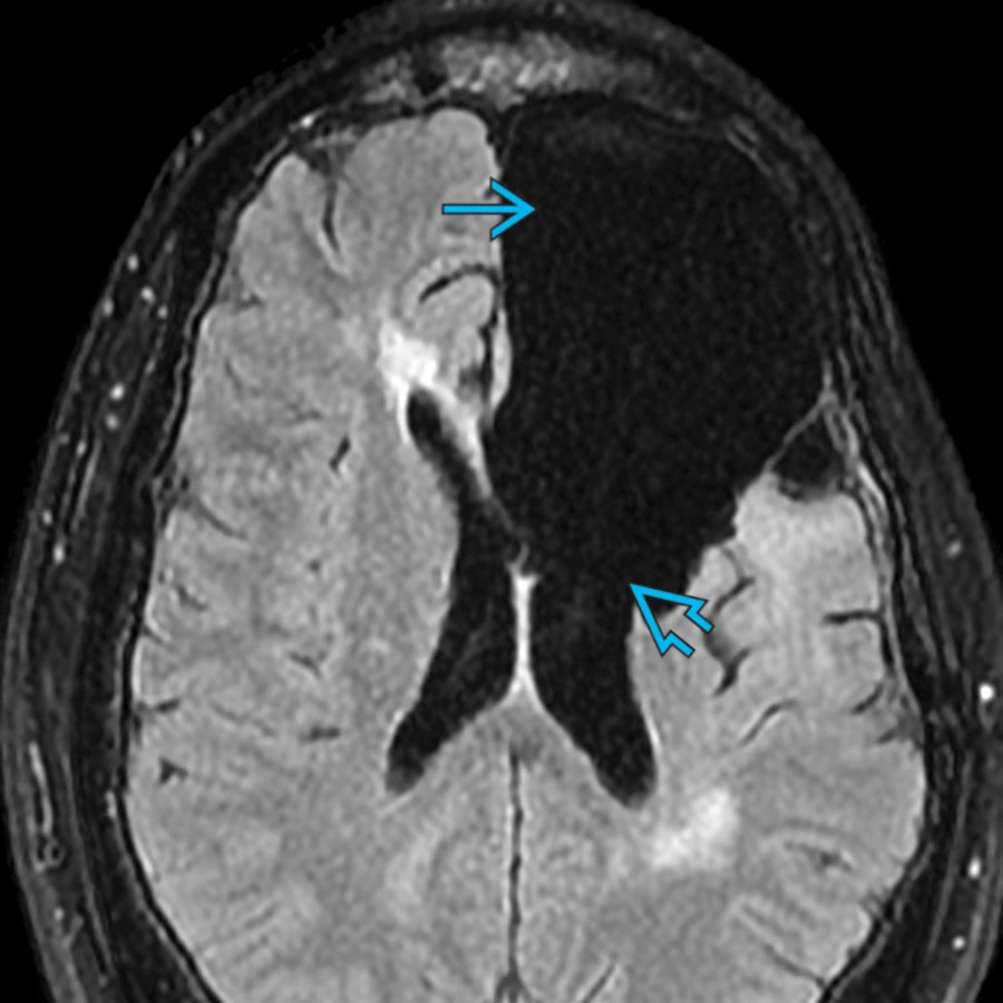 Axial FLAIR MR demonstrates a large surgical defect in the left frontal lobe  due to prior tumor resection communicating with the left lateral ventricle , which appears irregular.