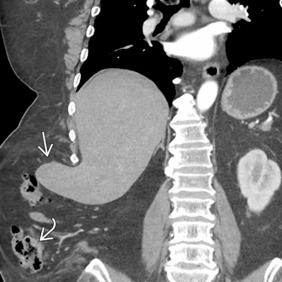 Coronal CECT demonstrates a large right-sided lumbar hernia containing a long segment of the colon  and a portion of the liver .