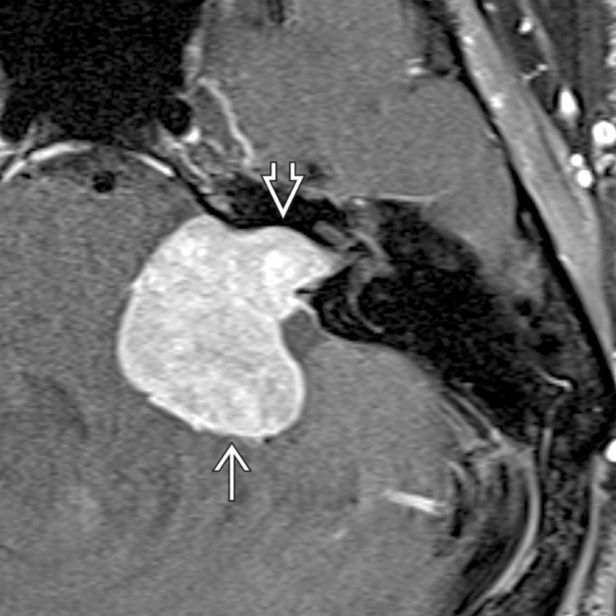 Axial T1 C+ FS MR shows a large, avidly enhancing left CPA-IAC vestibular schwannoma  that markedly enlarges the IAC  as well as exerts mass effect upon the adjacent pons, brachium pontis, and cerebellum.