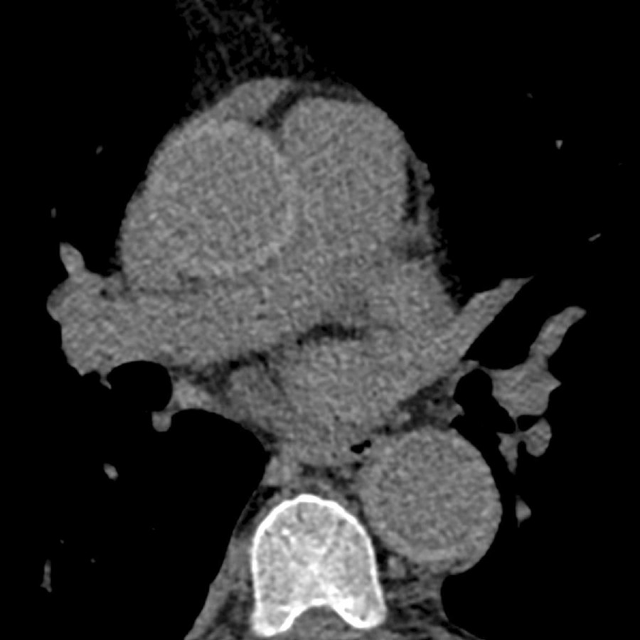 Axial NECT in a patient with Erdheim-Chester disease and mild chest pain shows that the circumferential aortic wall thickening is hyperattenuating, measuring 60 HU, and could mimic an intramural hematoma.