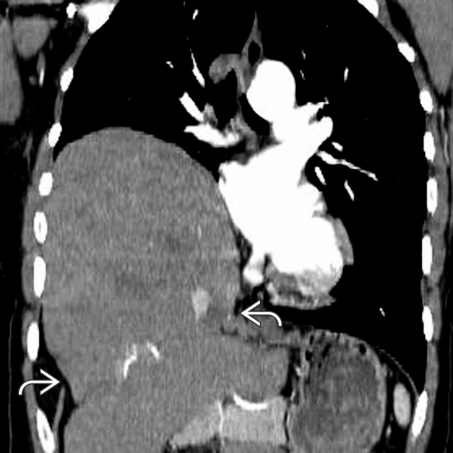 Coronal chest CTA in the same patient demonstrates characteristic right diaphragmatic rupture with the hourglass sign of the liver and a frank hemidiaphragmatic defect .