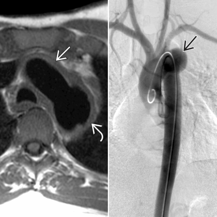 Composite image with axial T1 MR (left) and DSA (right) shows aortic wall thickening  and a focal aneurysm  confirmed on subtraction aortic DSA .