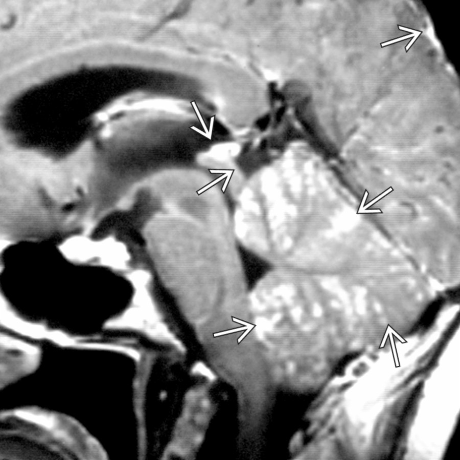 Sagittal T1 C+ MR shows typical leptomeningeal (pia and arachnoid) metastases  in the quadrigeminal cistern as well as widespread throughout the cerebellar folia.