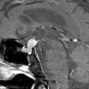 Sagittal T1 C+ MR shows a diffusely enhancing infundibular mass  in this 68-year-old woman with hypopituitarism. Pituicytomas are WHO grade I tumors with nuclear expression of TTF-1 that arise in the neurohypophysis or infundibulum.