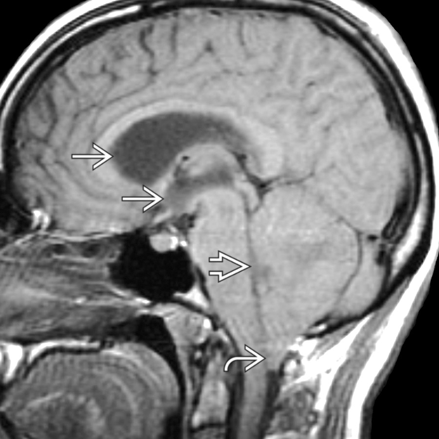 Sagittal T1WI MR shows cerebellar tonsillar herniation  from a large left posterior fossa mass. Note compression of 4th ventricle . Supratentorial ventricles are enlarged .