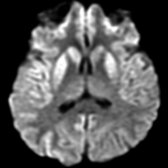 Axial DWI MR shows classic sCJD with diffusion restriction in the caudate and putamen as well as throughout the cortex. Frontal, temporal, and parietal cortical involvement is most common. Relative sparing of the pre- and postcentral gyri is typical of CJD.
