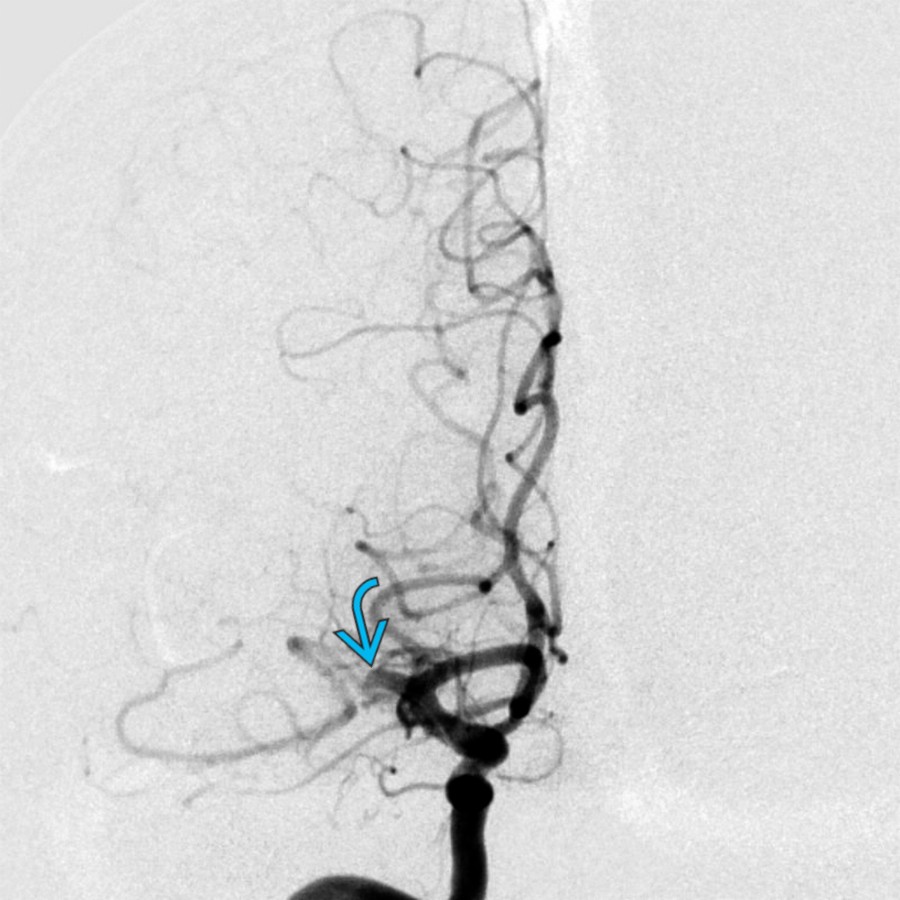 Right internal carotid DSA shows occlusion of the right MCA, M1 segment , corresponding to the CTA. Acute stroke therapy with mechanical thrombectomy was then performed.