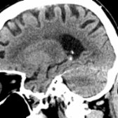 Sagittal NECT in the same patient demonstrates punctate calcification in the region of the tail of the hippocampus . Note normal calcification  in the choroid plexus within the atrium of the lateral ventricle. Hippocampal calcifications are seen with greater prevalence over the age of 50.