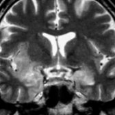 Coronal T2 MR in the same patient shows abnormal hyperintensity in both medial temporal lobes  and right insular cortex . Imaging of limbic encephalitis mimics that of herpes encephalitis; however, patients with limbic encephalitis have a subacute presentation. Hemorrhage suggests herpes rather than limbic encephalitis.