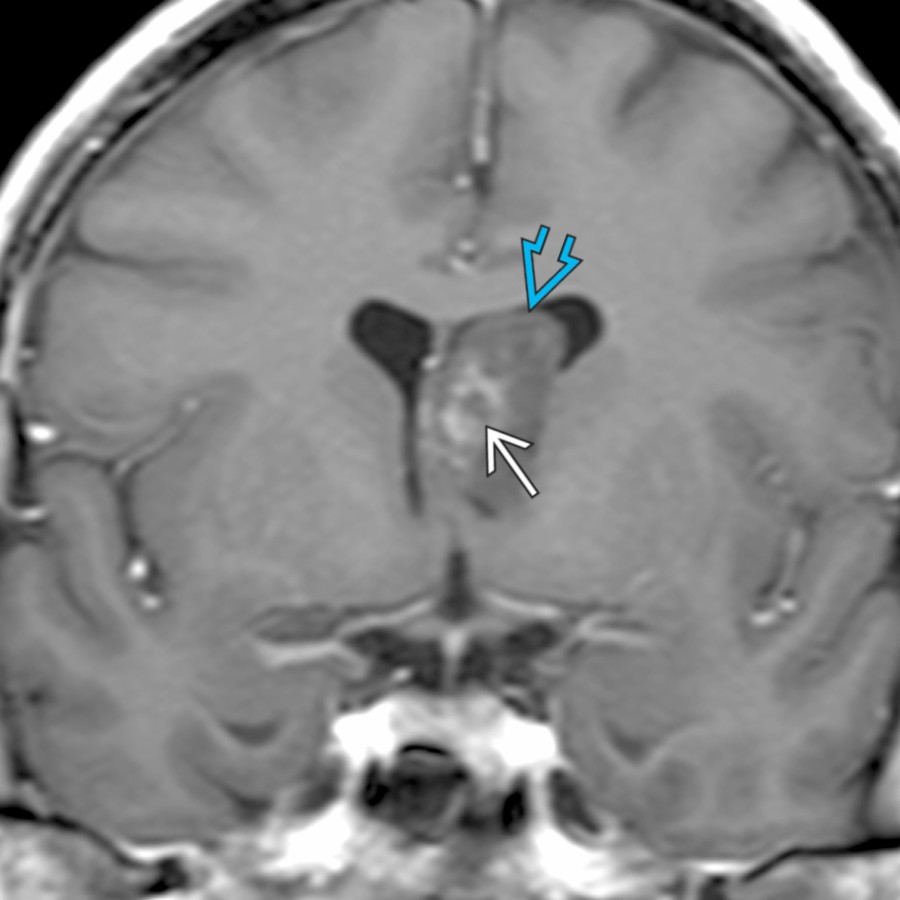 Coronal T1 C+ MR in a 35-year-old man shows a lateral ventricle mass  with central enhancement  and mild mass effect on the septum pellucidum. Note the lack of associated hydrocephalus, typical of a subependymoma.
