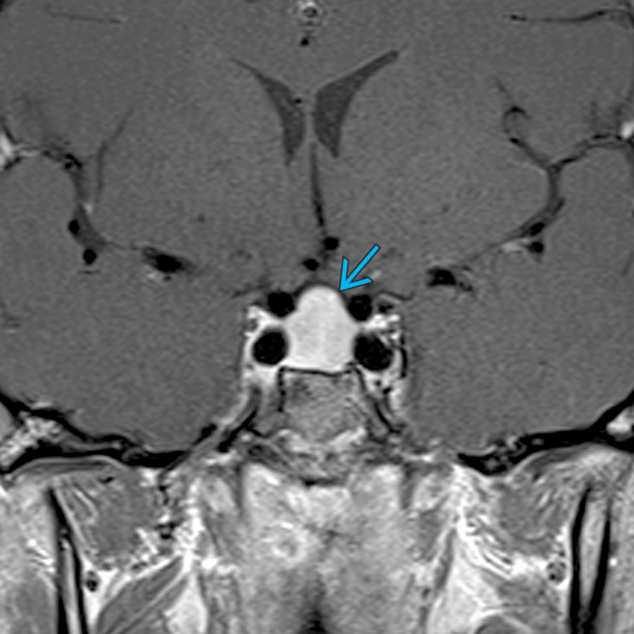 Coronal T1 C+ MR shows marked enlargement of the pituitary gland  without focal mass in this 18-year-old woman with hypothyroidism. Pituitary hyperplasia may be physiologic in menstruating, pregnant, or postpartum patients or pathologic, related to end-organ failure.