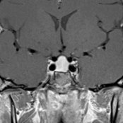 Coronal T1 C+ MR shows marked enlargement of the pituitary gland  without focal mass in this 18-year-old woman with hypothyroidism. Pituitary hyperplasia may be physiologic in menstruating, pregnant, or postpartum patients or pathologic, related to end-organ failure.