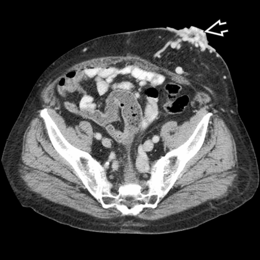 Axial CECT shows prominent parastomal varices .