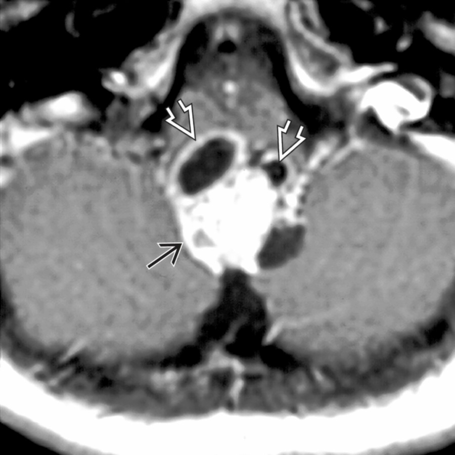 Axial T1 C+ MR demonstrates a heterogeneously enhancing ependymoma  containing cystic elements .