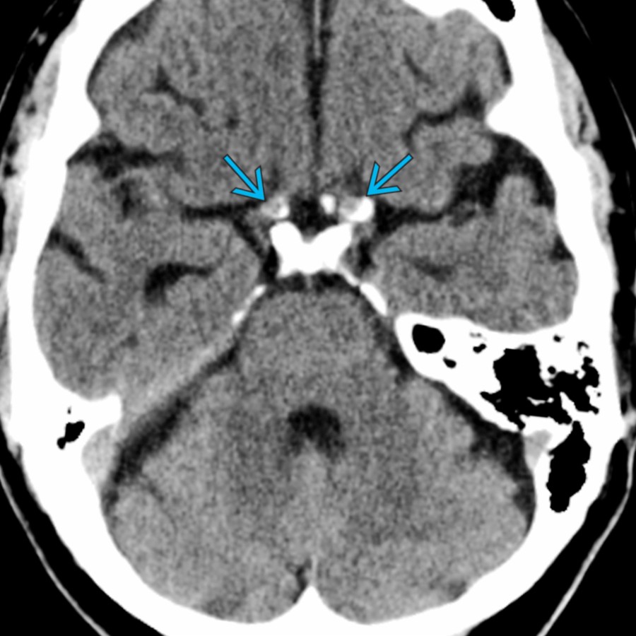 Axial NECT shows prominent calcific changes in both supraclinoid internal carotid arteries  caused by atherosclerosis. Intracranial atherosclerosis often involves the distal basilar artery and the cavernous and supraclinoid internal carotid arteries. There is often mural calcification and decreased vessel caliber.