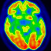 Axial color-coded FDG PET in a 65-year-old man with apathy & slowly progressive behavioral changes with clinical diagnosis of bvFTD shows decreased metabolic activity in bilateral anterior & medial temporal lobes  with relative sparing of bilateral parietooccipital lobes .