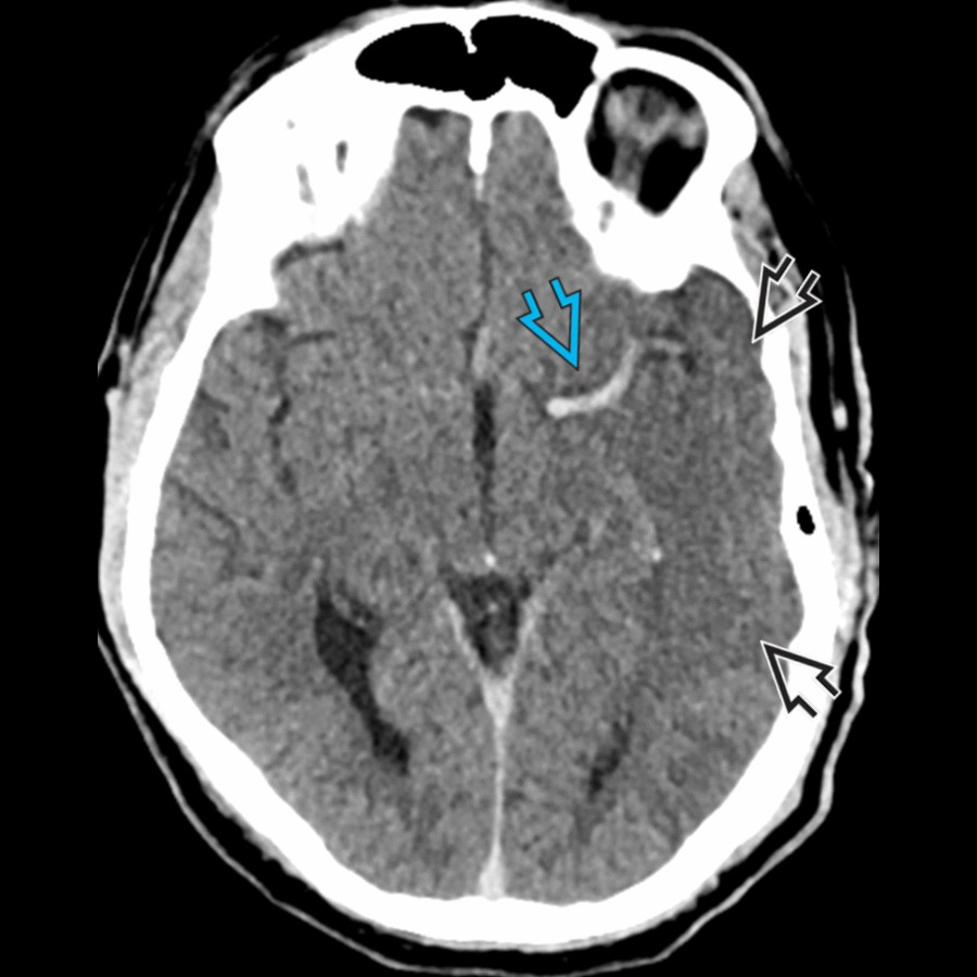 Axial NECT shows ↑ density in the left MCA   (dense MCA sign) in a patient with acute right-sided symptoms. The density is from acute thrombus within the vessel. Note the associated loss of gray-white differentiation in the MCA territory .