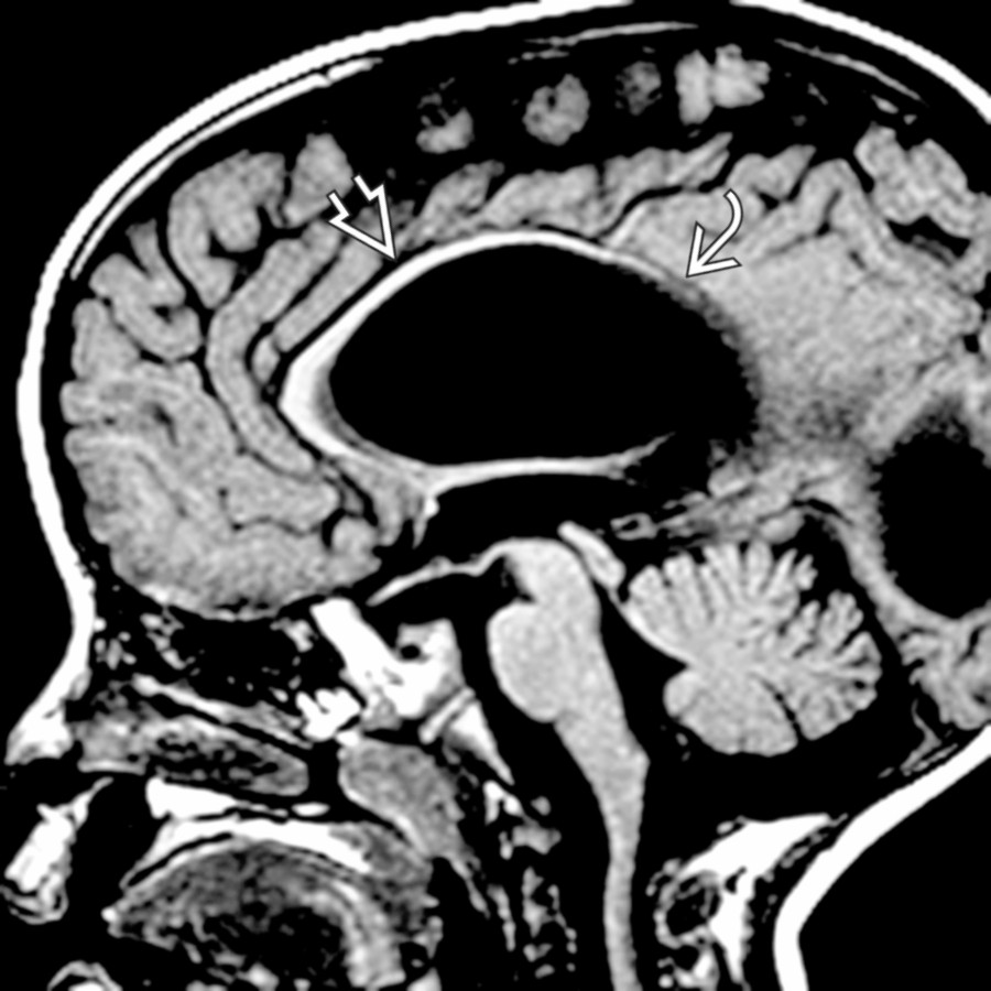 Midline sagittal T1 MR shows marked callosal thinning  in a child whose hydrocephalus follows unilateral grade 4 intraventricular hemorrhage. Note the more severe callosal volume loss posteriorly .