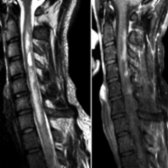 Sagittal T2 (left) and T1WI C+ FS (right) images show multilevel T2 hyperintensity with irregular posterior enhancement  in the cervical cord in a patient with a previous history of optic neuritis.