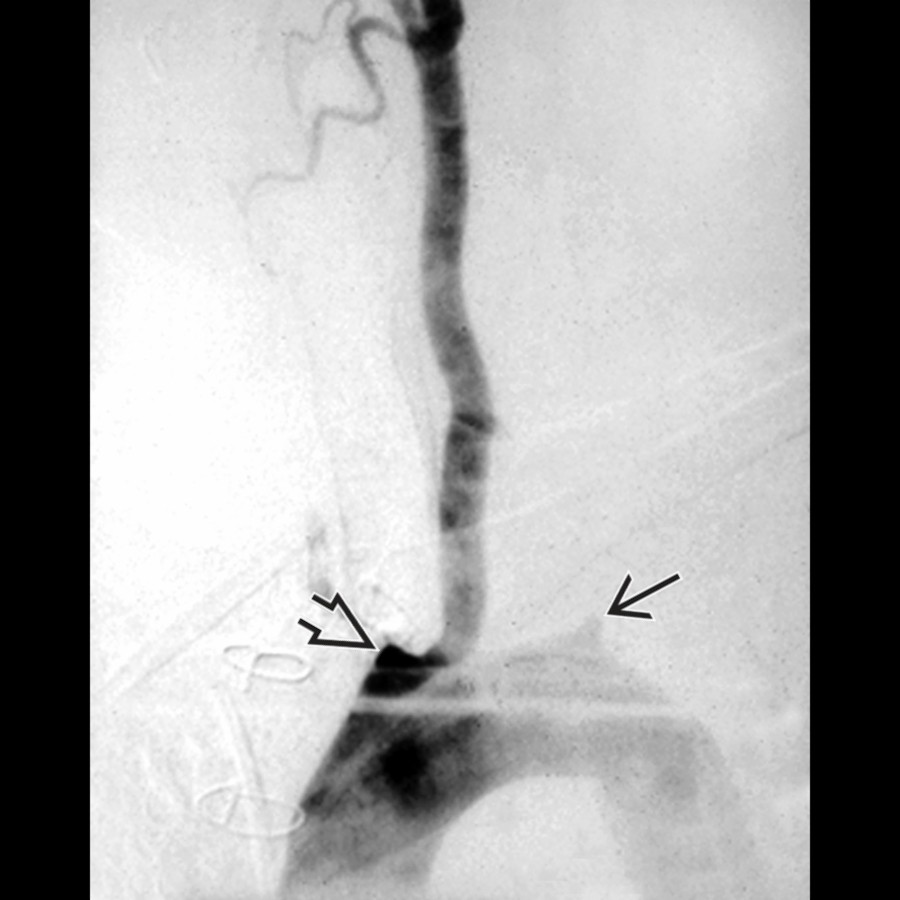 Sagittal oblique DSA in another patient with TA shows patency of the left common carotid artery with occlusion of the right brachiocephalic  and left subclavian arteries .