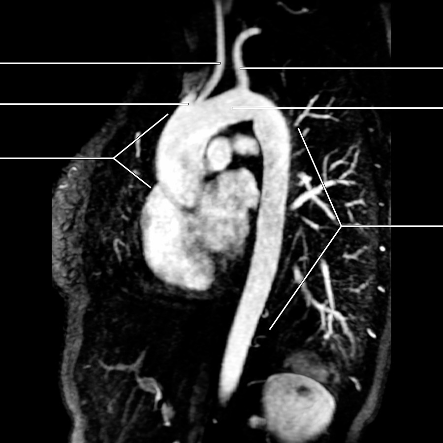 "Candy cane" view of an MRA shows a thoracic aorta.