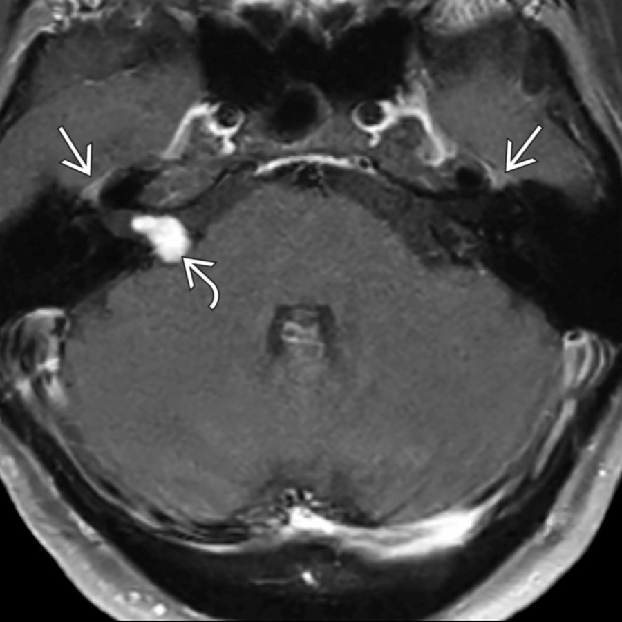 Typical normal enhancement pattern of facial intratemporal facial nerves in a patient with vestibular schwannoma is shown. On this axial MR, the geniculate ganglia (triangular structures superolateral to the IAC)  demonstrate moderate symmetric enhancement. Right vestibular schwannoma is noted .
