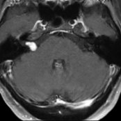 Typical normal enhancement pattern of facial intratemporal facial nerves in a patient with vestibular schwannoma is shown. On this axial MR, the geniculate ganglia (triangular structures superolateral to the IAC)  demonstrate moderate symmetric enhancement. Right vestibular schwannoma is noted .